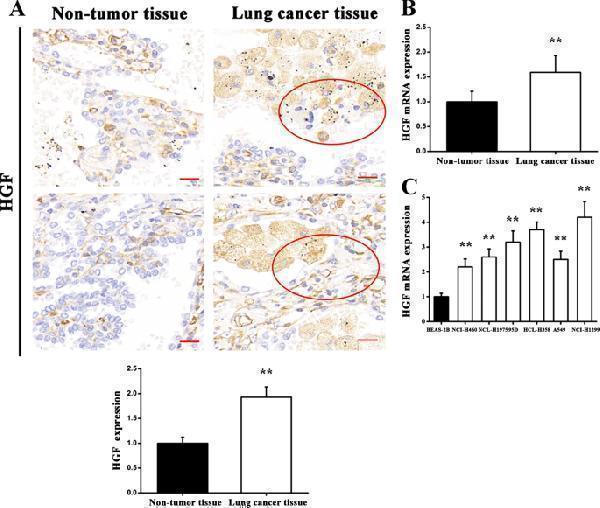 HGF expression levels in lung cancer tissues and various lung cancer lines