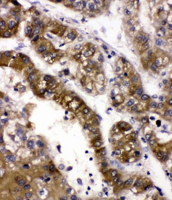 IHC analysis of ADH5 using anti-ADH5 antibody (RP1111). ADH5 was detected in paraffin-embedded section of human liver cancer tissues. Heat mediated antigen retrieval was performed in citrate buffer (pH6, epitope retrieval solution) for 20 mins. The tissue section was blocked with 10% goat serum. The tissue section was then incubated with 1μg/ml rabbit anti-ADH5 Antibody (RP1111) overnight at 4°C. Biotinylated goat anti-rabbit IgG was used as secondary antibody and incubated for 30 minutes at 37°C. The tissue section was developed using Strepavidin-Biotin-Complex (SABC)(Catalog # SA1022) with DAB as the chromogen.