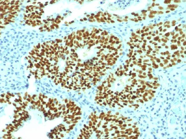 SOX2 antibody used in cervical carcinoma study